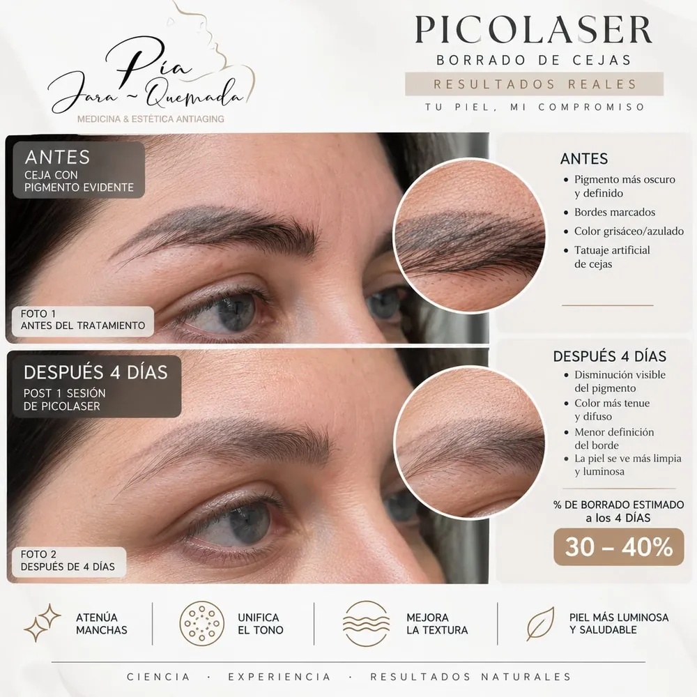 Infografía de borrado de cejas con Picolaser en Maipú: antes y después de una sesión