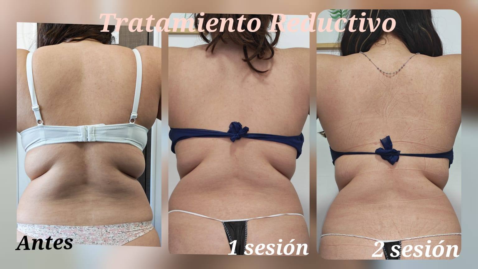 Resultados de tratamiento reductivo en Maipú: comparación antes, primera sesión y segunda sesión