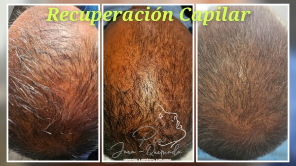 Tratatamiento de recuperación capilar Femenino y Masculino - Imagen 2