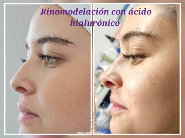 Rinomodelación con Ácido Hialurónico - Imagen 2