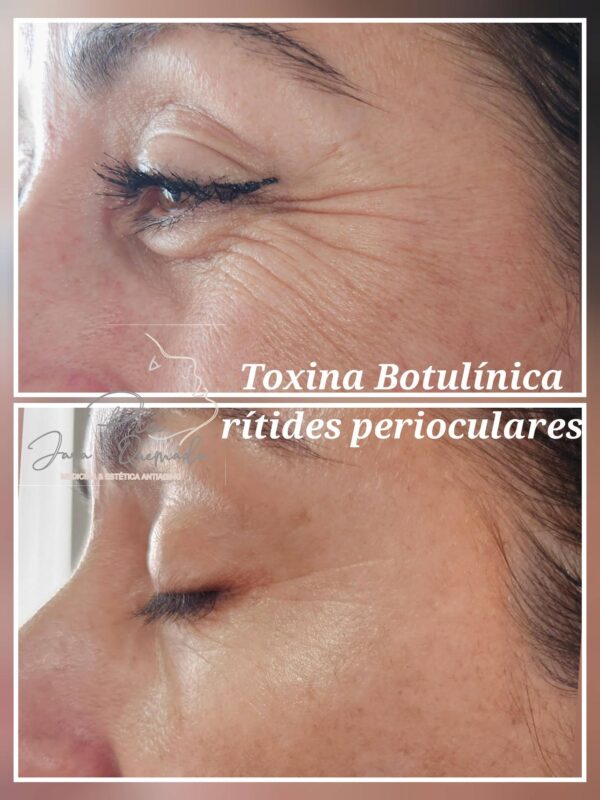 Toxina Botulínica - Imagen 7