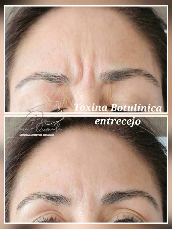 Toxina Botulínica - Imagen 3