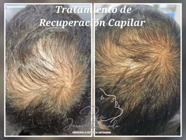 Tratatamiento de recuperación capilar Femenino y Masculino - Imagen 4