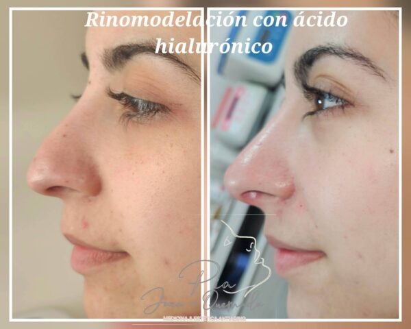 Rinomodelación con Ácido Hialurónico - Imagen 5
