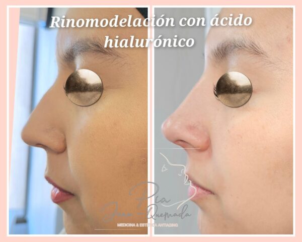 Rinomodelación con Ácido Hialurónico - Imagen 3