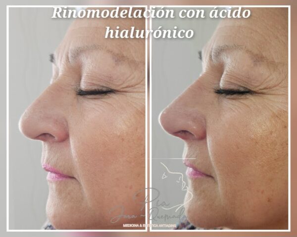Rinomodelación con Ácido Hialurónico - Imagen 7