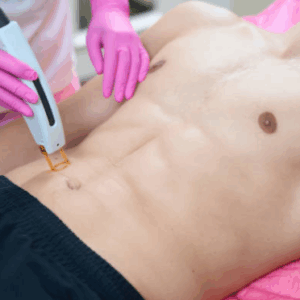 Depilación Tri-Láser Abdomen  (Masculino)