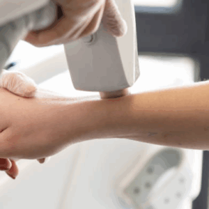 Depilación Tri-Láser Brazo superior (Femenino)