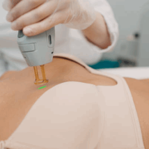 Depilación Tri-Láser Pecho (Femenino)